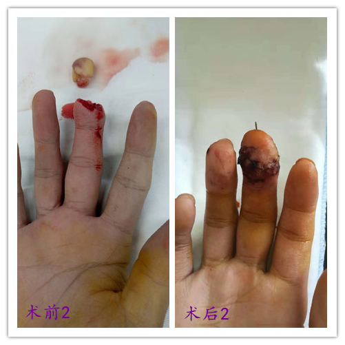 赣州三康医院2例末节手指离断再植成功