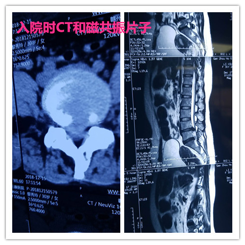 治疗腰间盘突出症 赣州三康医院有妙招